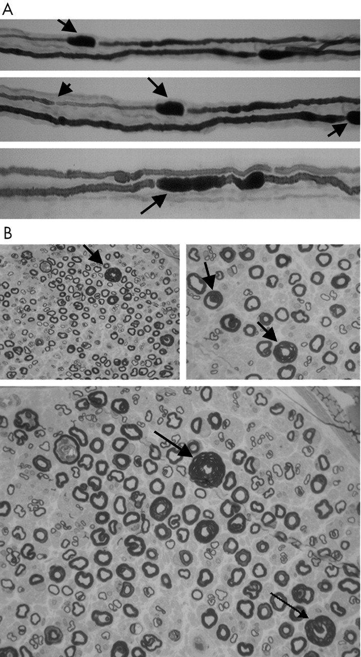 jnnp-2004-November-75-11-1629-F1.large